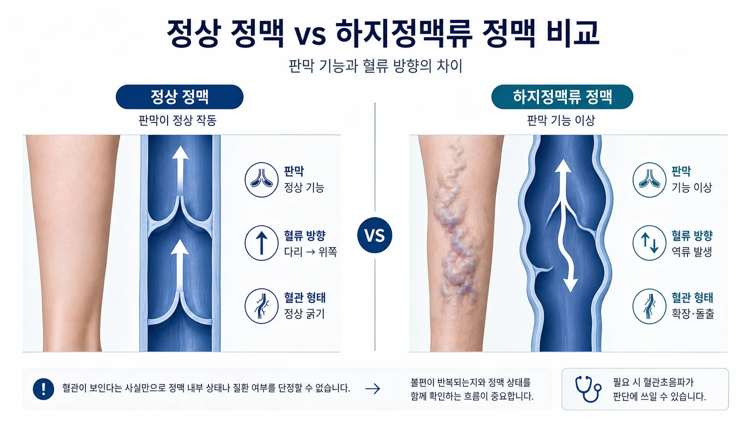 정상 정맥과 확장되어 돌출된 하지정맥류 정맥, 판막과 혈류 방향을 비교한 그림